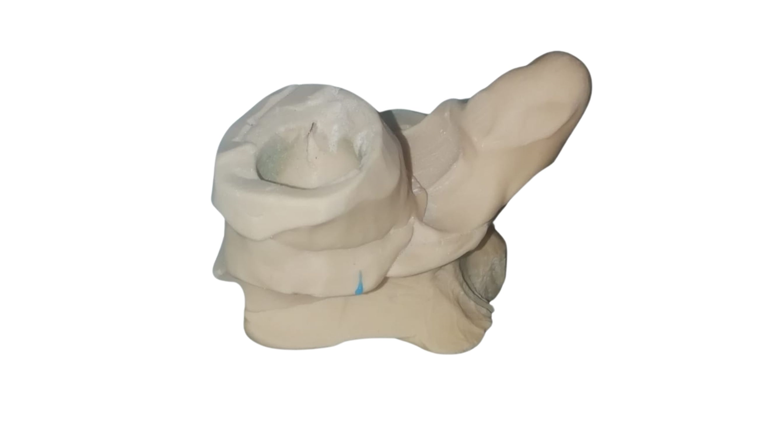 protesi replicata da a3ds con reverse engineeringe stampa 3d